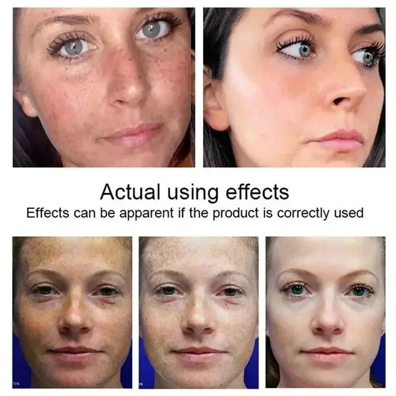 Jaysuing Kojic Acid Brightening & Whitening Serum – Dark Spots, Freckles & Melasma Corrector