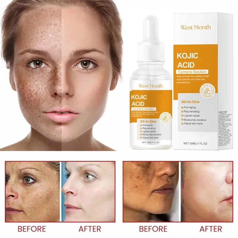 Jaysuing Kojic Acid Brightening & Whitening Serum – Dark Spots, Freckles & Melasma Corrector