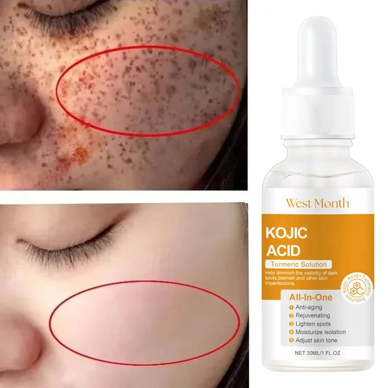 Jaysuing Kojic Acid Brightening & Whitening Serum – Dark Spots, Freckles & Melasma Corrector